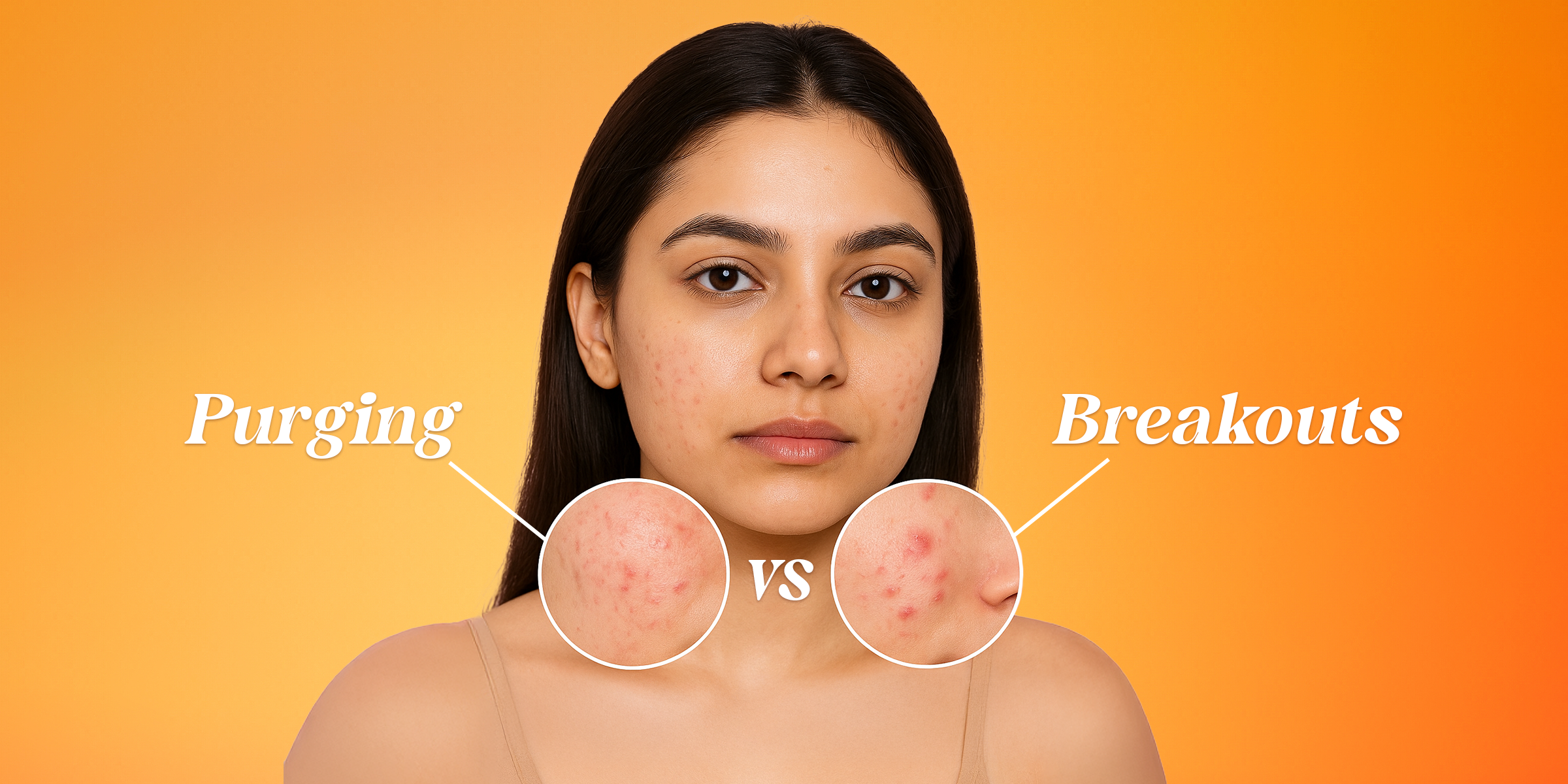 Difference Between Skin Purging vs. Breakouts