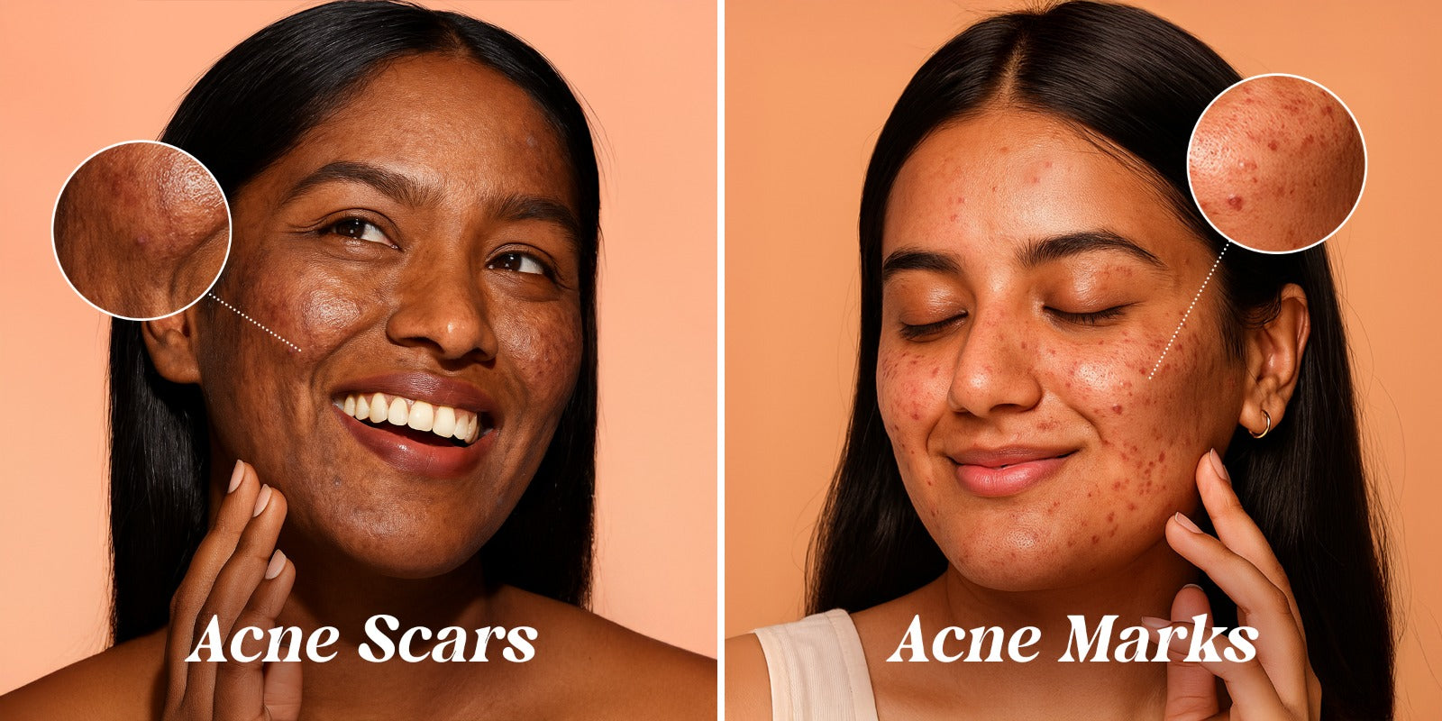 Acne Marks Vs Acne Scars