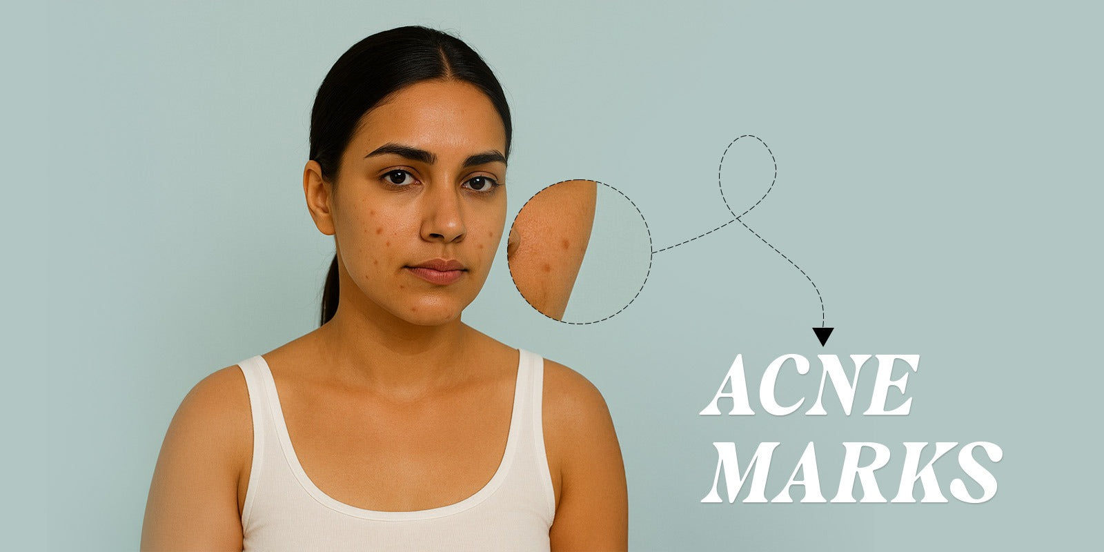 Acne Marks Vs Acne Scars - Difference, Types & Treatments